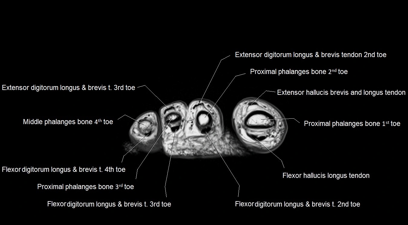 MRI 3T foot axial cross sectional anatomy image 34.webp